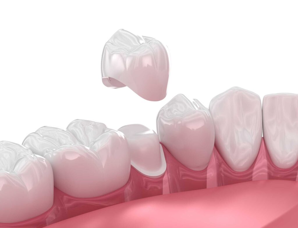 Dental Crown Placement in McAllen, TX